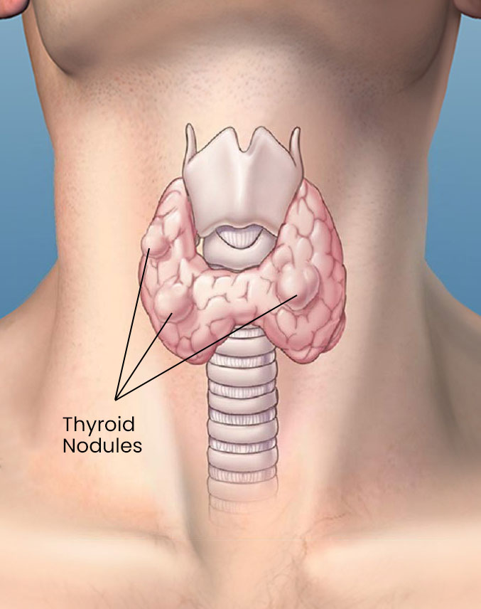 Imgs-Thyroid-Nodules