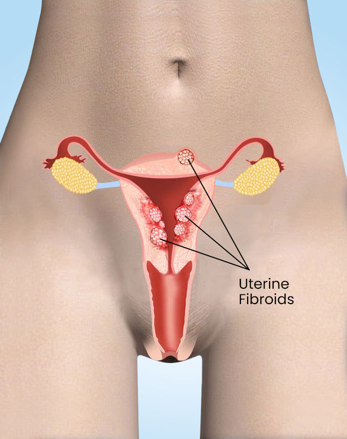 uterine-fibroids-1