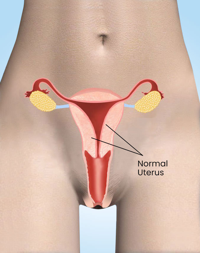 uterine-fibroids-2